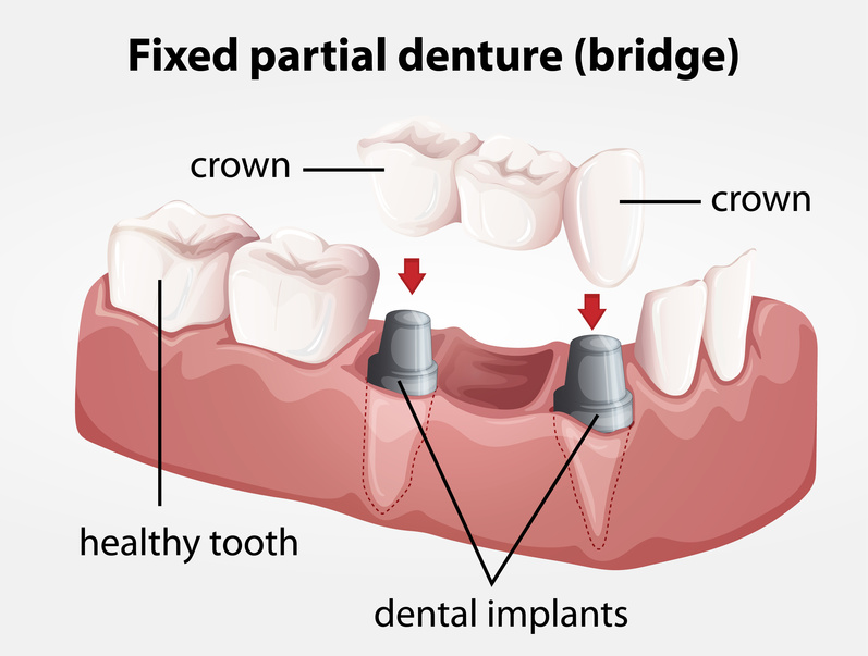 Huntington Park CA Dental Implants